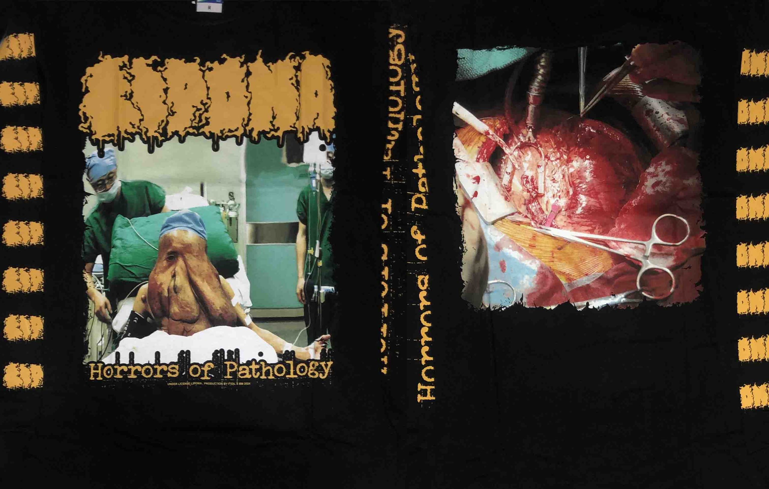 LS – LIPOMA – Horrors Of Pathology