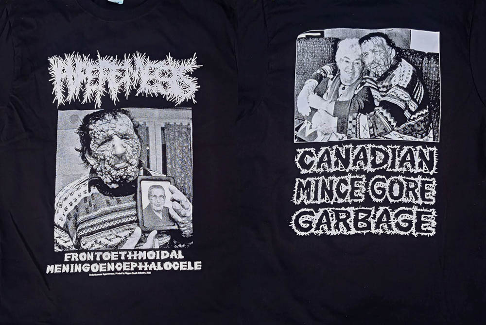 TS - HYPEREMESIS - FRONTOETHMOIDAL MENINGOENCEPHALOCELE