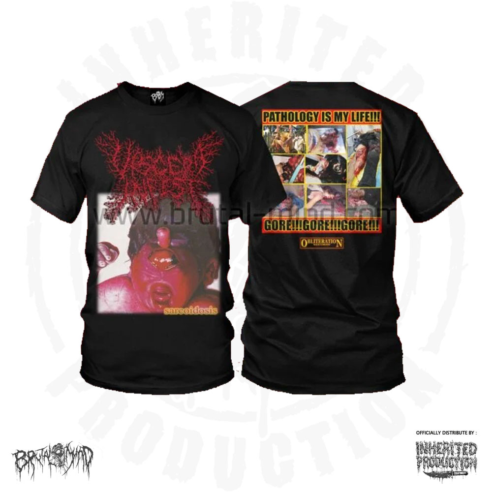 TS - VISECERA INFEST - Sarcoidosis